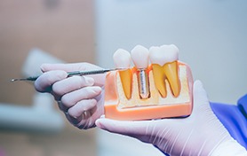 dental professional holding a model of a dental implant