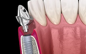 diagram of an implant abutment