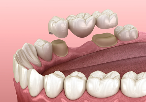 Animated dental bridge being fitted to replace a missing tooth