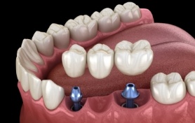 Animated dental bridge supported by two dental implants