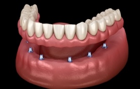 Animated full implant denture supported by six dental implants