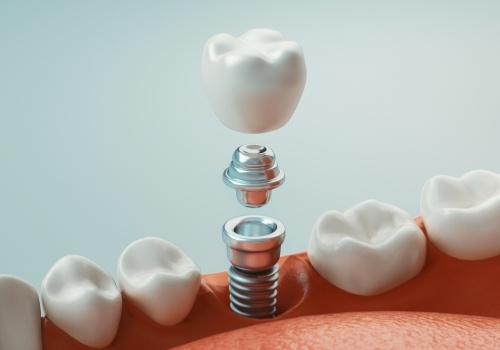 Animated dental implant with abutment and dental crown