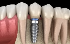 Animated dental implant in the lower jaw with dental crown