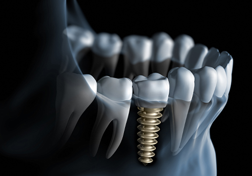 Animated model of a jaw with a dental implant