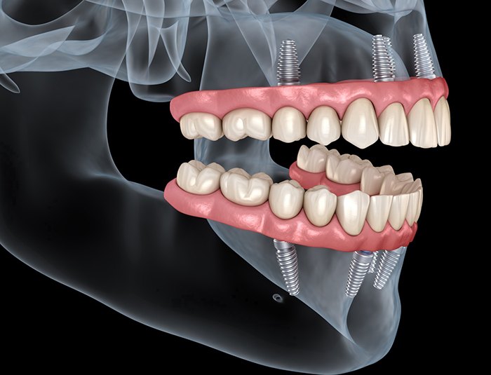 Implant dentures for upper and lower arches