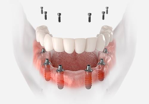 Illustration of implant denture for lower arch