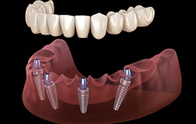 Implant denture pictured against dark background