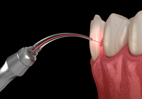 Animated soft tissue laser treating gum disease