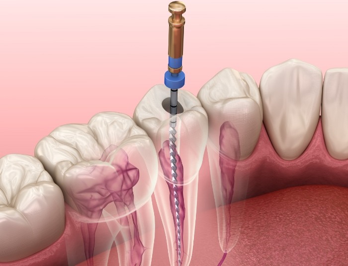 Animated dental instrument performing root canal treatment on a tooth