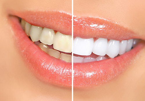 Women getting professional teeth whitening from cosmetic dentist