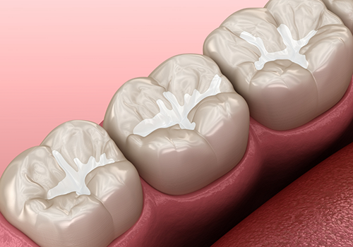 Animated row of teeth with tooth colored fillings
