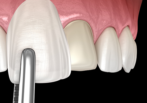Woman smiling while getting dental veneers from cosmetic dentist