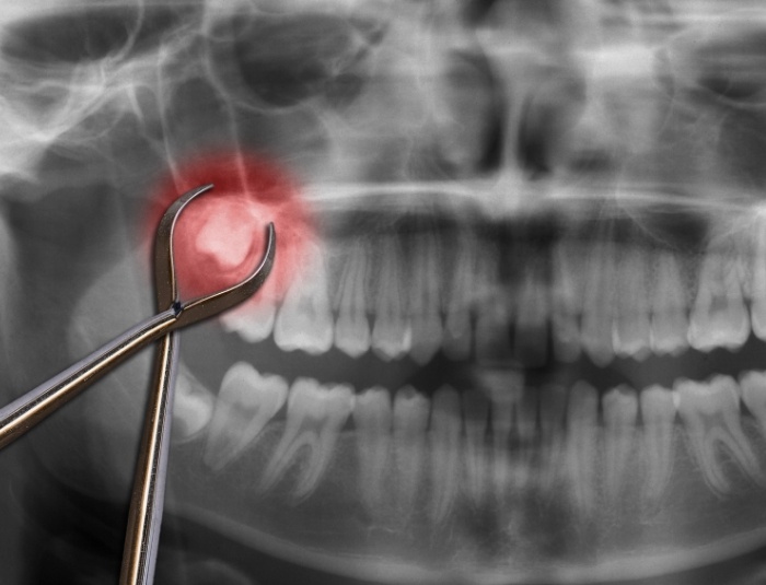 Dental forceps pointing to wisdom tooth on dental x ray highlighted in red